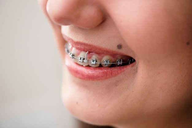 Dental Teeth Braces Treatment Noida