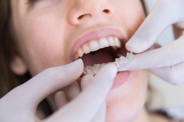 Best Orthodontic Treatment in Noida